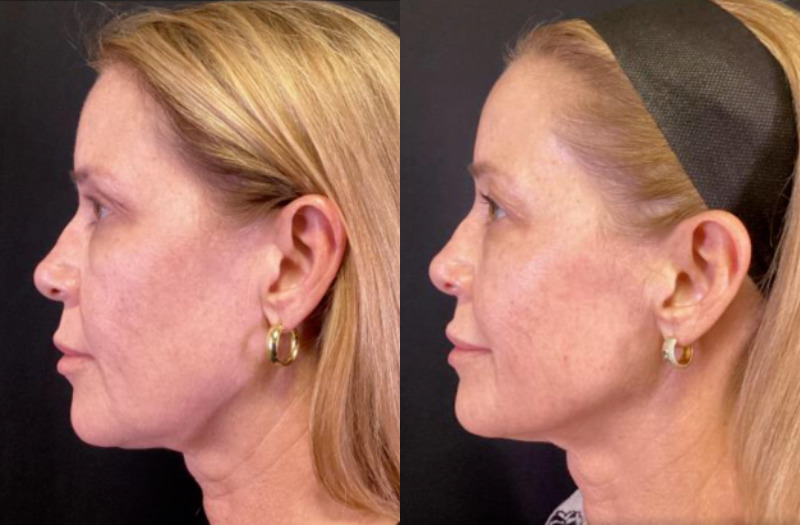 Sofwave™ Case 3 Marge Image