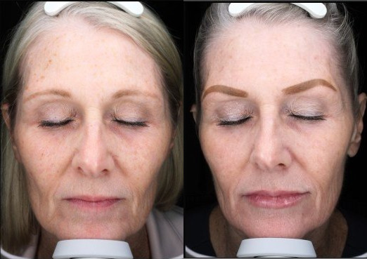 Sofwave™ BBL Therapy Combo Case 11 Marge Image