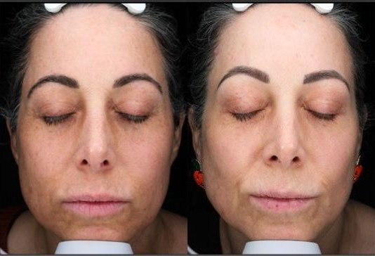 BBL Therapy Chemical Peel Combo Case 16 Marge Image