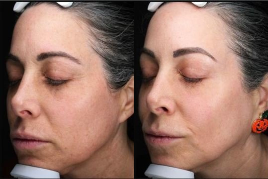BBL Therapy Chemical Peel Combo Case 16 Marge Image