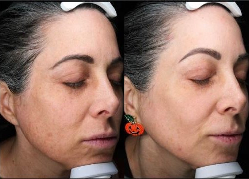BBL Therapy Chemical Peel Combo Case 16 Marge Image