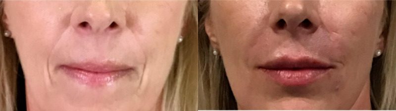 Dermal Fillers Case 75 Marge Image