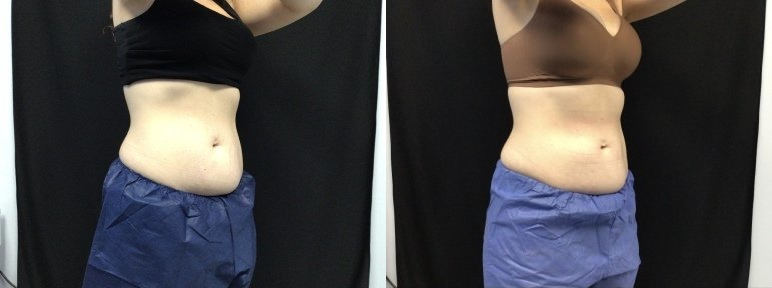 Coolsculpting® ELITE Case 55 Marge Image