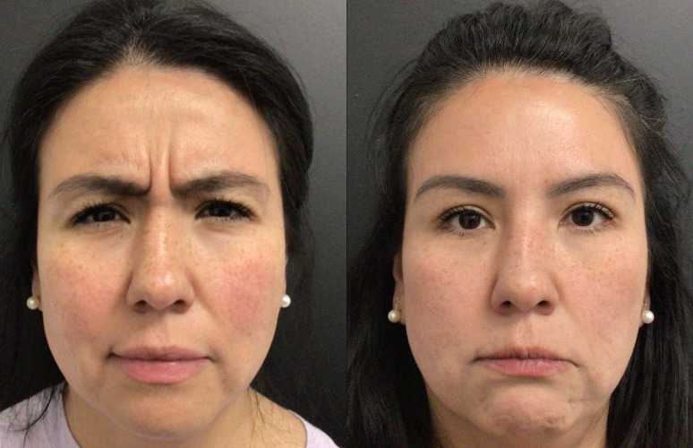 Botox® / Dysport® Case 71 Marge Image