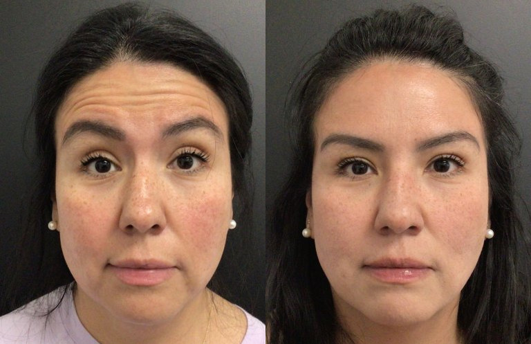 Botox® / Dysport® Case 71 Marge Image