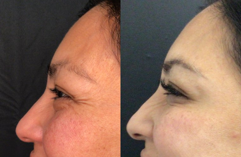 Botox® / Dysport® Case 72 Marge Image