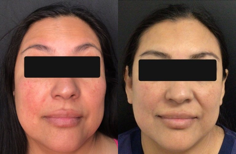 Botox® / Dysport® Case 72 Marge Image