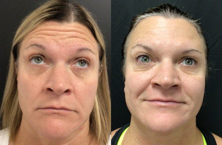 Botox® / Dysport® Case 73 Marge Image