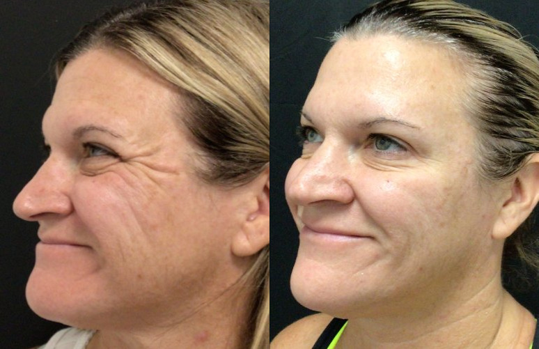 Botox® / Dysport® Case 73 Marge Image