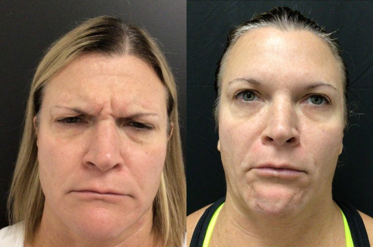 Botox® / Dysport® Case 73 Marge Image