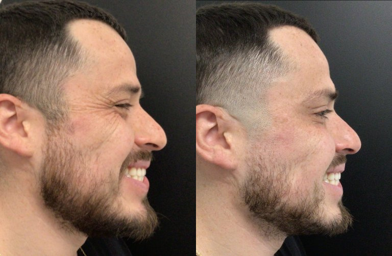 Botox® / Dysport® Case 74 Marge Image