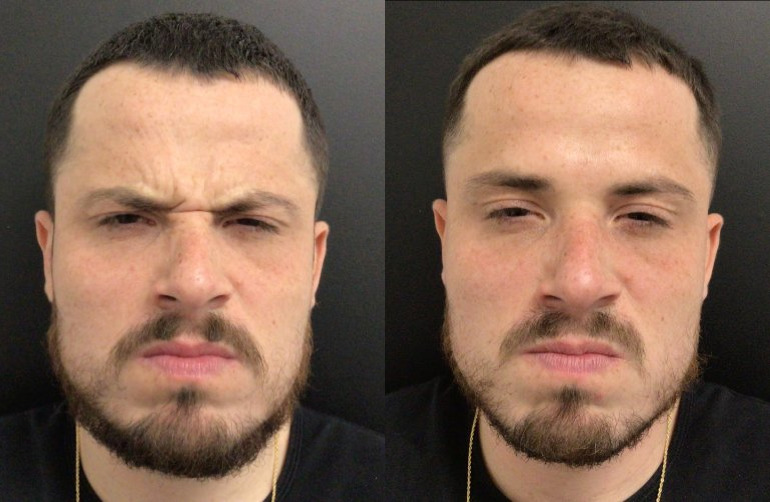 Botox® / Dysport® Case 74 Marge Image