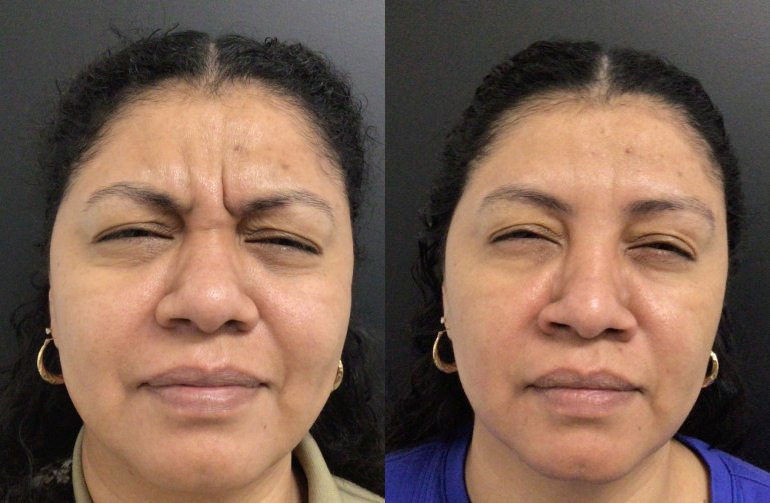 Botox® / Dysport® Case 75 Marge Image