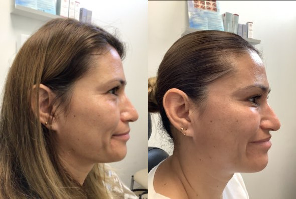 Botox® / Dysport® Case 82 Marge Image