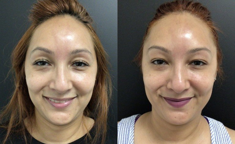 Botox® / Dysport® Case 76 Marge Image