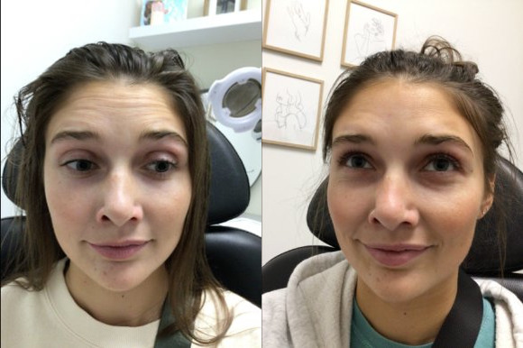 Botox® / Dysport® Case 77 Marge Image