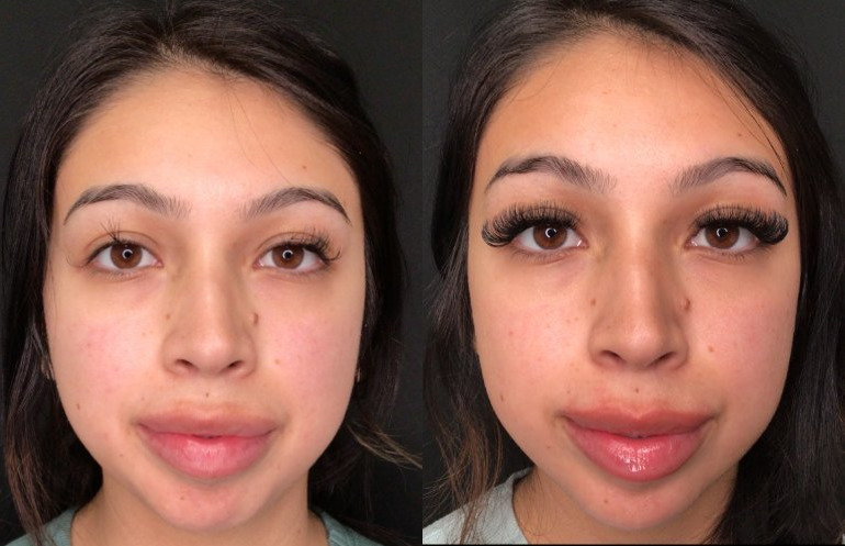 Botox® / Dysport® Case 78 Marge Image