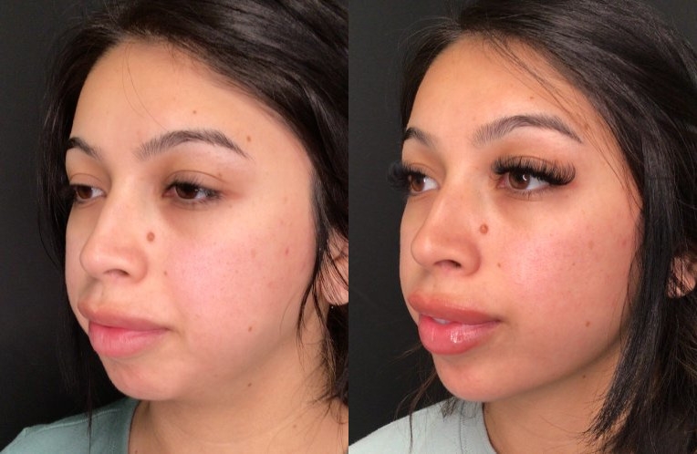 Botox® / Dysport® Case 78 Marge Image