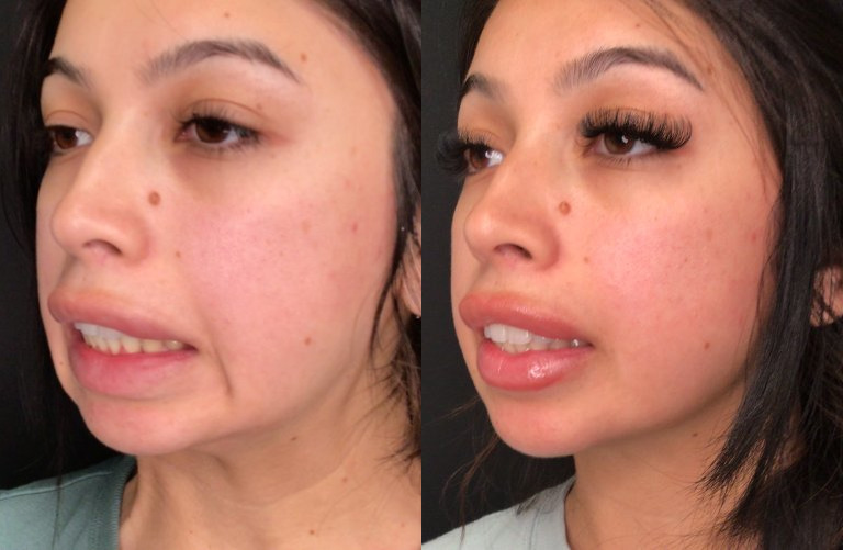 Botox® / Dysport® Case 78 Marge Image