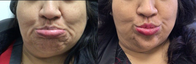 Botox® / Dysport® Case 79 Marge Image