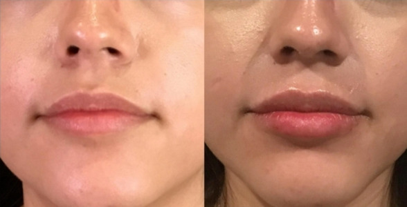 Lip Injections Case 65 Marge Image