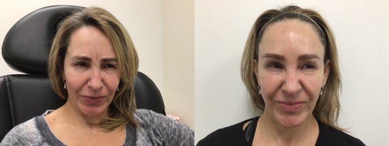 Botox® / Dysport® Case 80 Marge Image