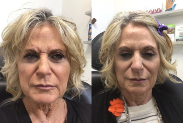 Botox® / Dysport® Case 81 Marge Image