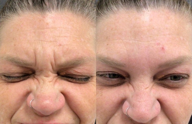 Botox® / Dysport® Case 60 Marge Image