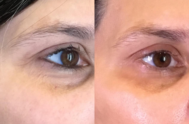 SkinPen® Microneedling BBL Therapy Case 4 Marge Image