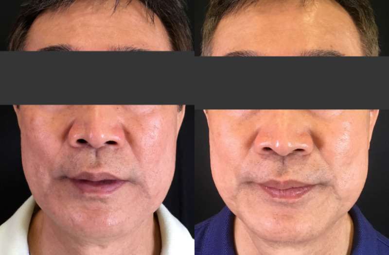 SkinPen® Microneedling BBL Therapy Case 3 Marge Image