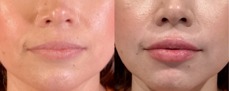 Lip Injections Case 63 Marge Image