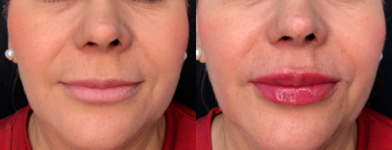 Lip Injections Case 70 Marge Image