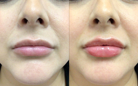 Lip Injections Case 73 Marge Image