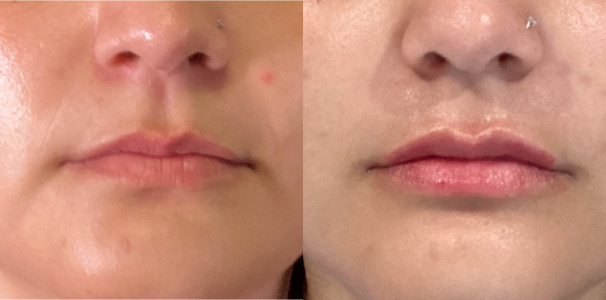 Lip Injections Case 60 Marge Image