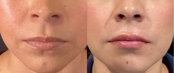 Lip Injections Case 62 Marge Image