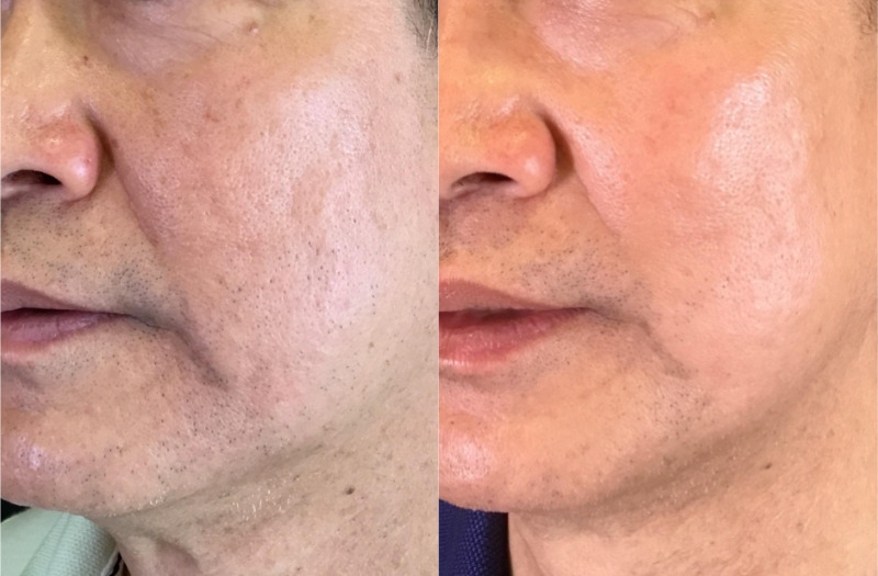 SkinPen® Microneedling BBL Therapy Case 3 Marge Image