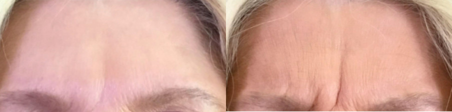 Botox® / Dysport® Case 59 Marge Image