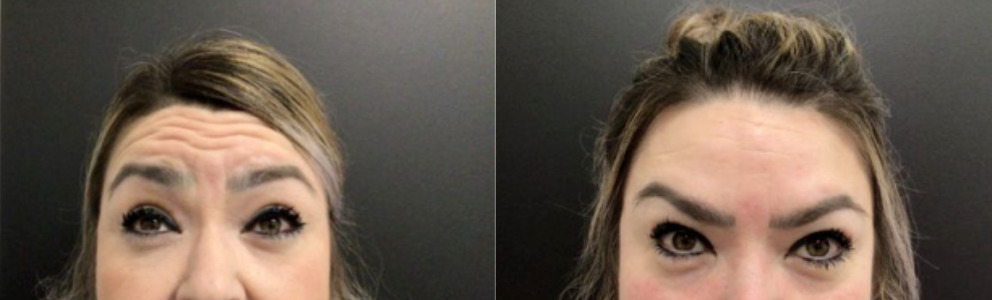 Botox® / Dysport® Case 66 Marge Image