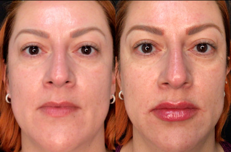 Lip Injections Case 71 Marge Image