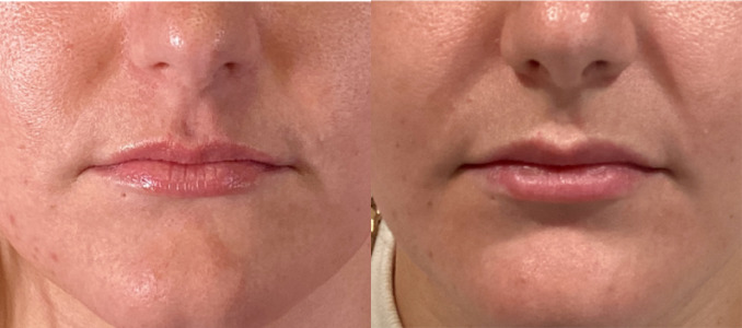 Lip Injections Case 61 Marge Image