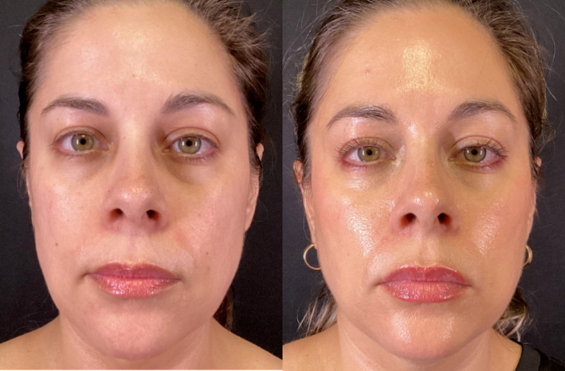 Dermal Fillers Case 76 Marge Image