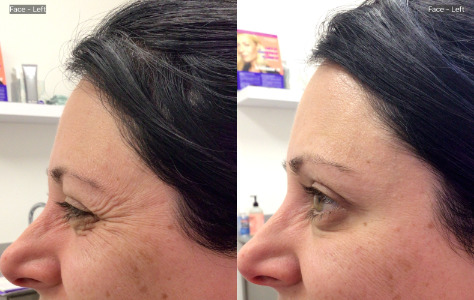 Botox® / Dysport® Case 62 Marge Image