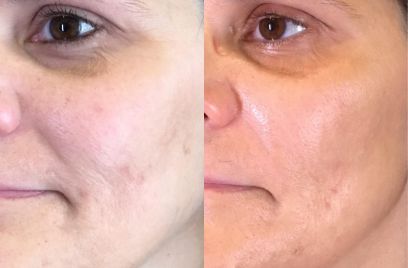 SkinPen® Microneedling BBL Therapy Case 4 Marge Image