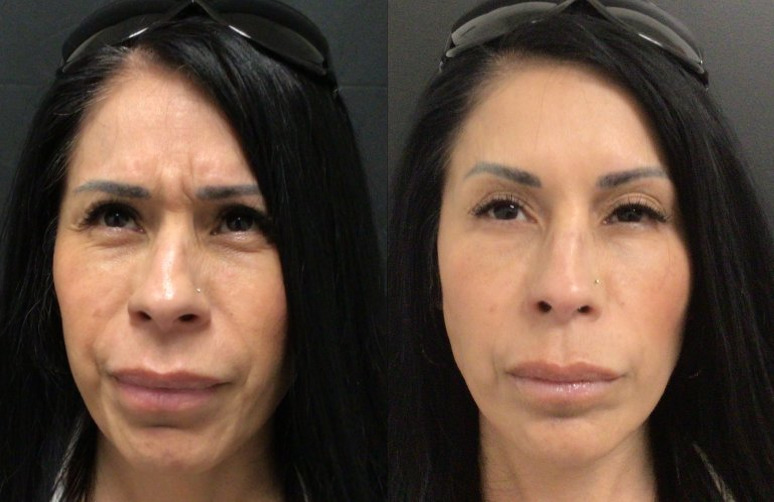 Botox® / Dysport® Case 70 Marge Image