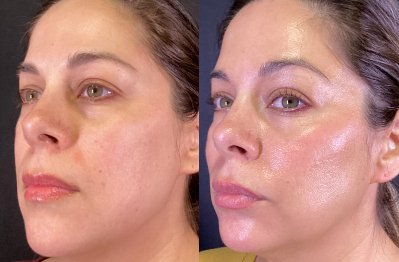 Dermal Fillers Case 76 Marge Image