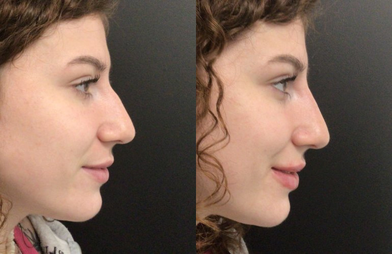 Dermal Fillers Case 78 Marge Image