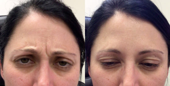 Botox® / Dysport® Case 62 Marge Image