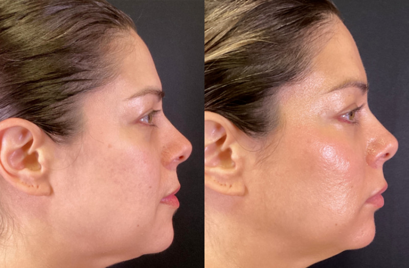 Dermal Fillers Case 76 Marge Image
