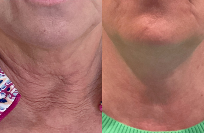 Biostimulator Case 1 Marge Image