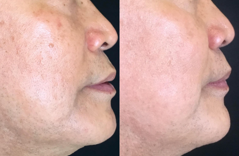 SkinPen® Microneedling BBL Therapy Case 3 Marge Image
